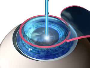 Refractive Eye Surgery