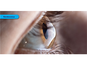 Early Diagnosis & Management of Keratoconus